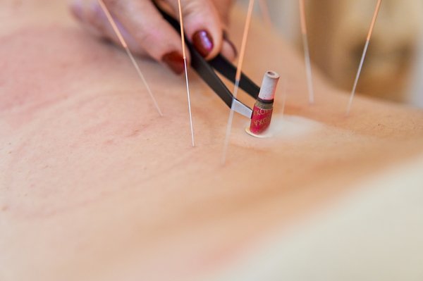 Trouver un acupuncteur à Marseille 13008 pour votre santé